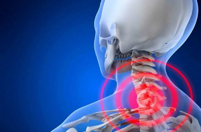 Osteochondrose der Halsspalte