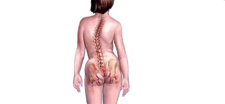 Osteochondrose