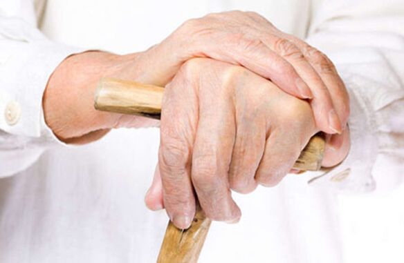 Arthrose der Finger bei einer älteren Person