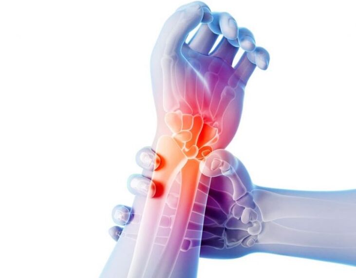 Arthrose der Gelenke geht mit Schmerzen einher und erfordert eine komplexe Behandlung